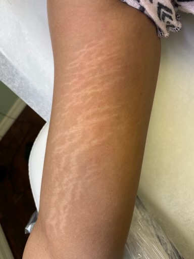 Inkless stretch mark tattoo results before and after at Healing Skin