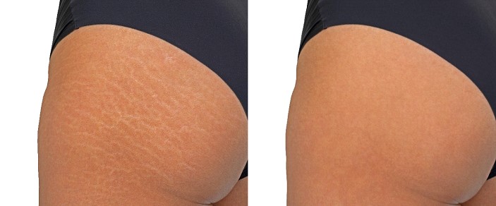 Brazilian Stretch Mark Camouflage