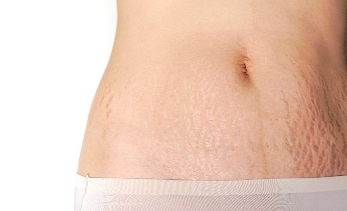 Inkless Stretchmark Medical Tattoos