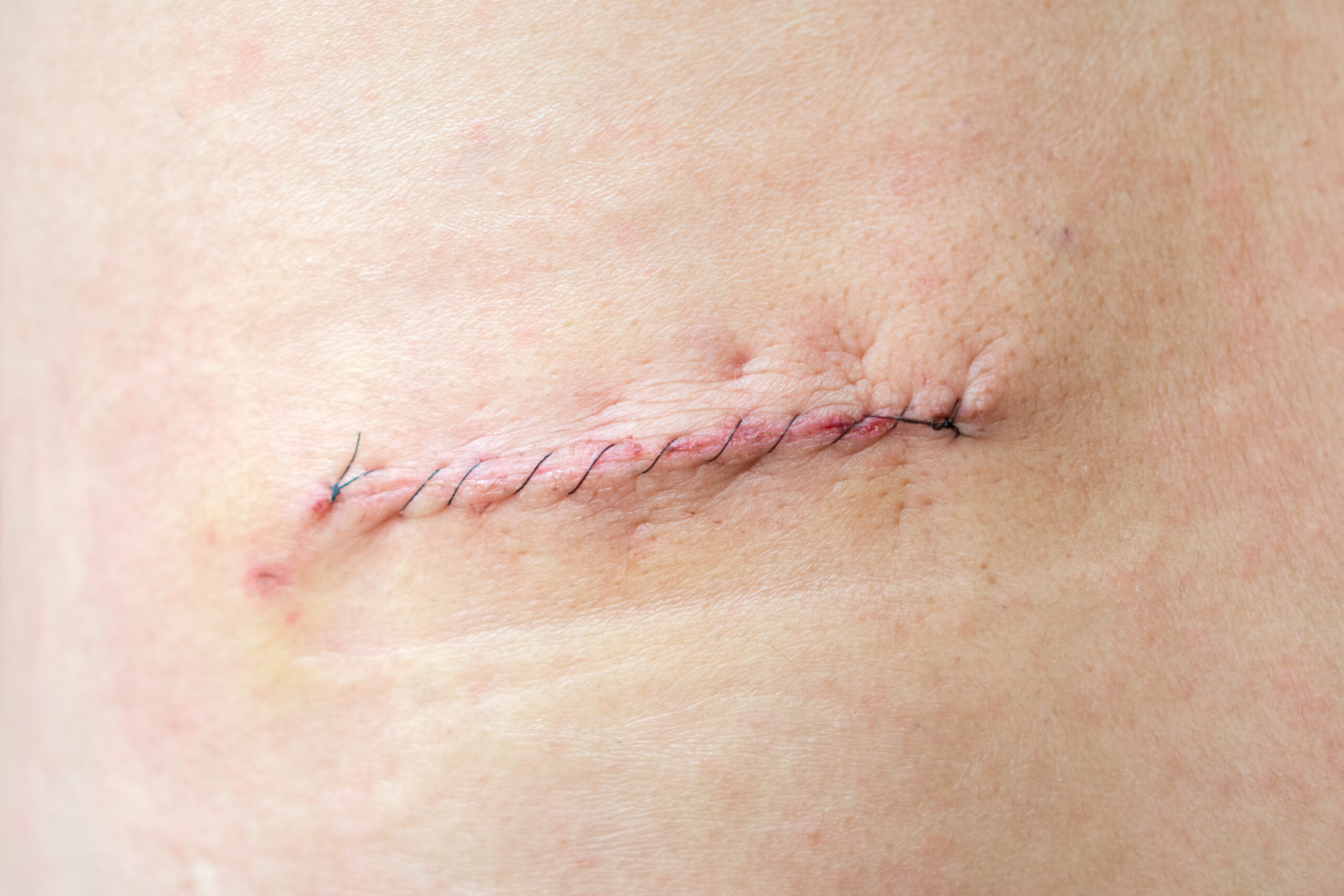 Learn effective scar camouflage techniques to conceal scars. Explore makeup and products to hide scars and regain confidence. Click to explore the best ways to camouflage scars and achieve a seamless, natural appearance.