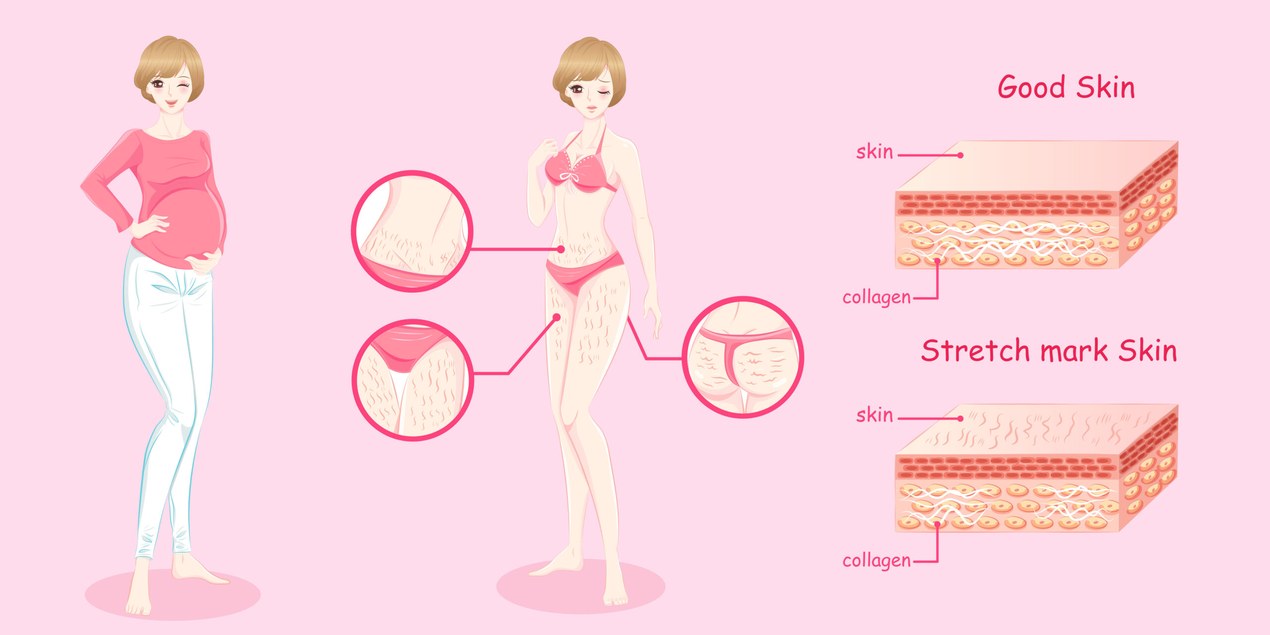 Adopt lifestyle changes to prevent Brazilian stretch marks. Explore habits and practices that contribute to Brazilian stretch mark prevention. Click to learn how to make positive changes in your daily life to minimize the risk of Brazilian stretch marks.