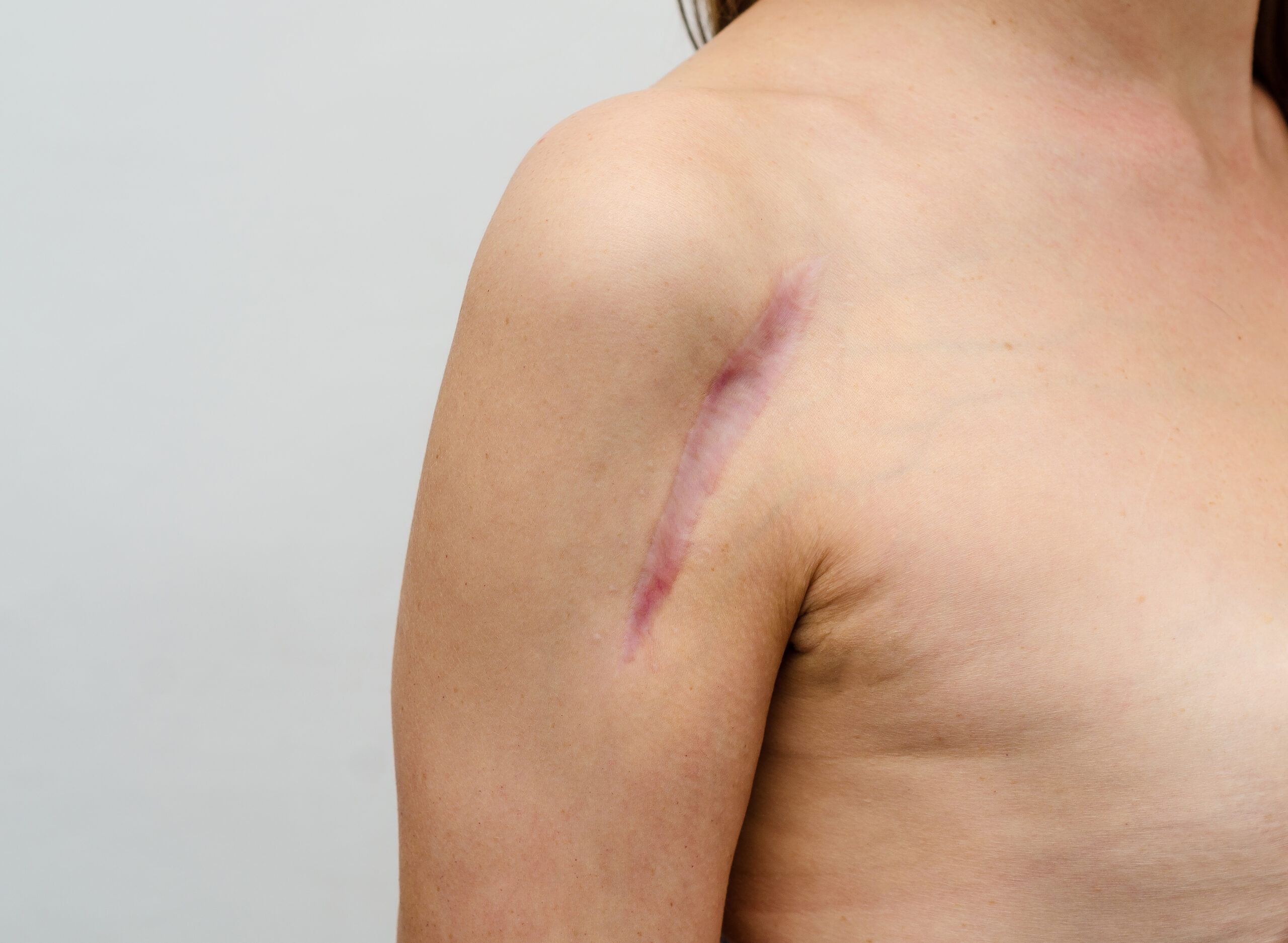 Use makeup to effectively camouflage scars. Discover expert tips and tricks for hiding scars with makeup. Click to find out how to create flawless coverage and reduce the visibility of scars for a more confident look.