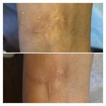 Advanced ISR inkless scar revision treatment showing serum-based microneedling technique on stretch marks at Healing Skin Medical Aesthetics