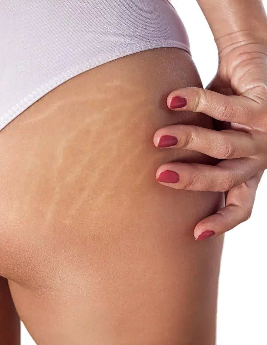 Advanced ISR Inkless Stretch Mark
