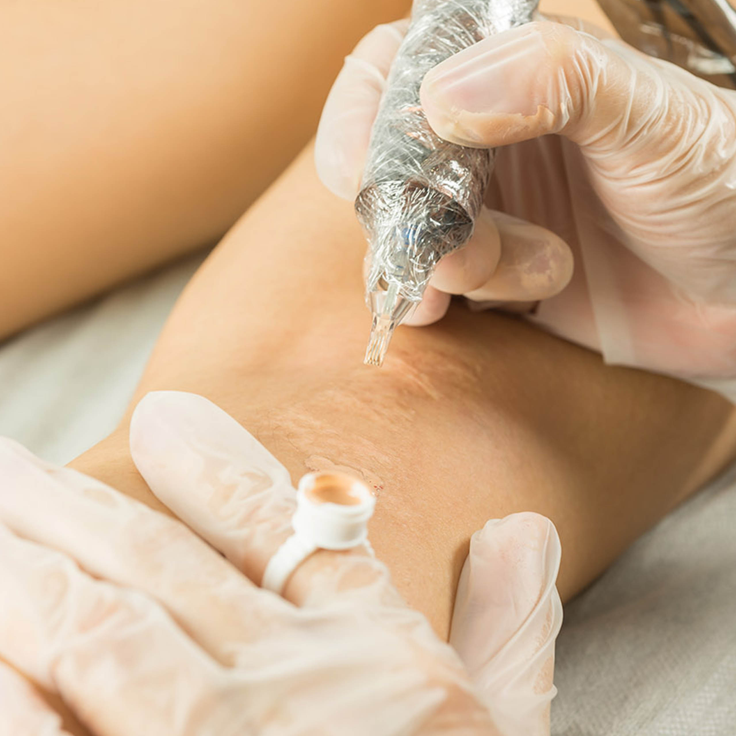 Scar Camouflage Orlando at Healing Skin Medical Aesthetics by Dr. Cecilia Rusnak