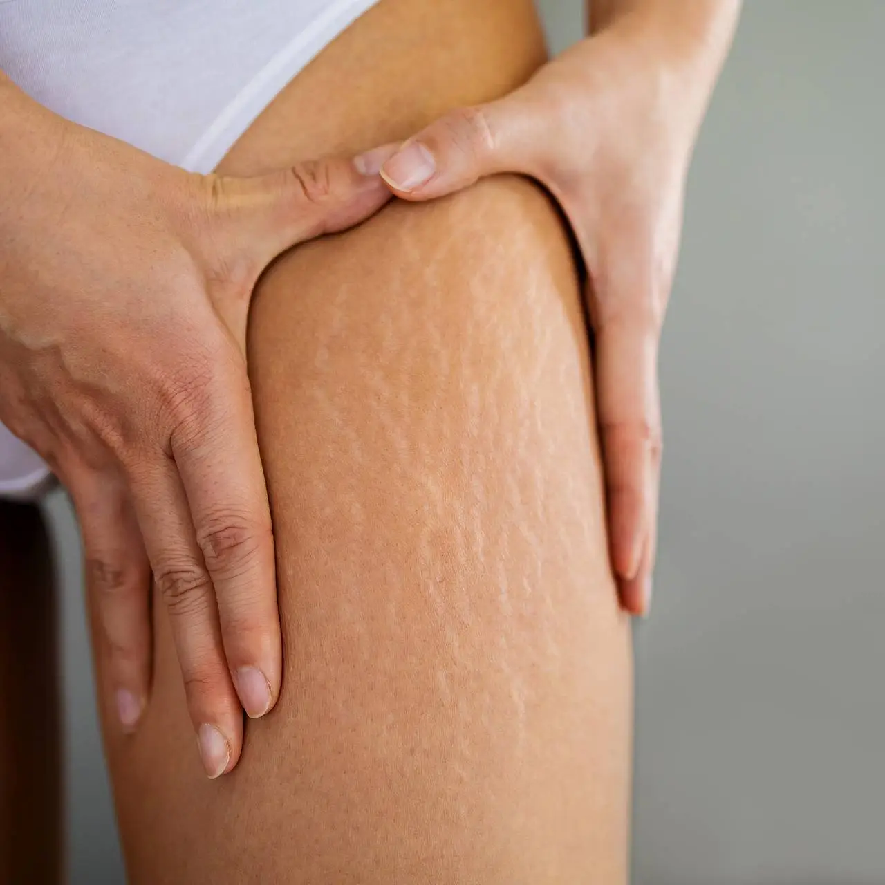 Stretch Mark Camouflage.