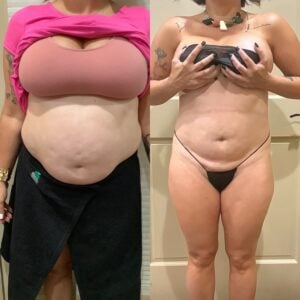 Before and after scar camouflage treatment at Healing Skin Medical Aesthetics paramedical tattoo clinic Florida showing tummy tuck scar revision