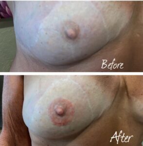 3D areola tattoo before and after on breast cancer survivor as part of insurance-covered reconstruction