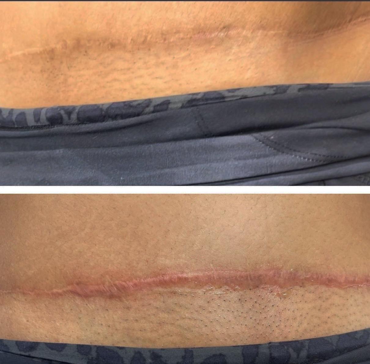 Scar camouflage Orlando before and after at Healing Skin Medical Aesthetics in Kissimmee Florida