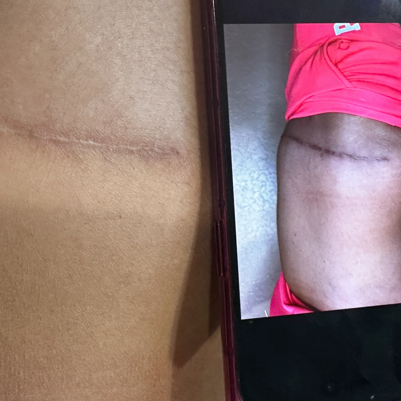 Hypertrophic vs keloid scar treatment considerations on melanin-rich skin at Healing Skin Medical Aesthetics