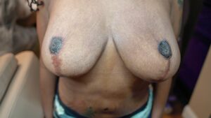 Before and after scar camouflage dark skin treatment showing stretch mark revision on Fitzpatrick type V client