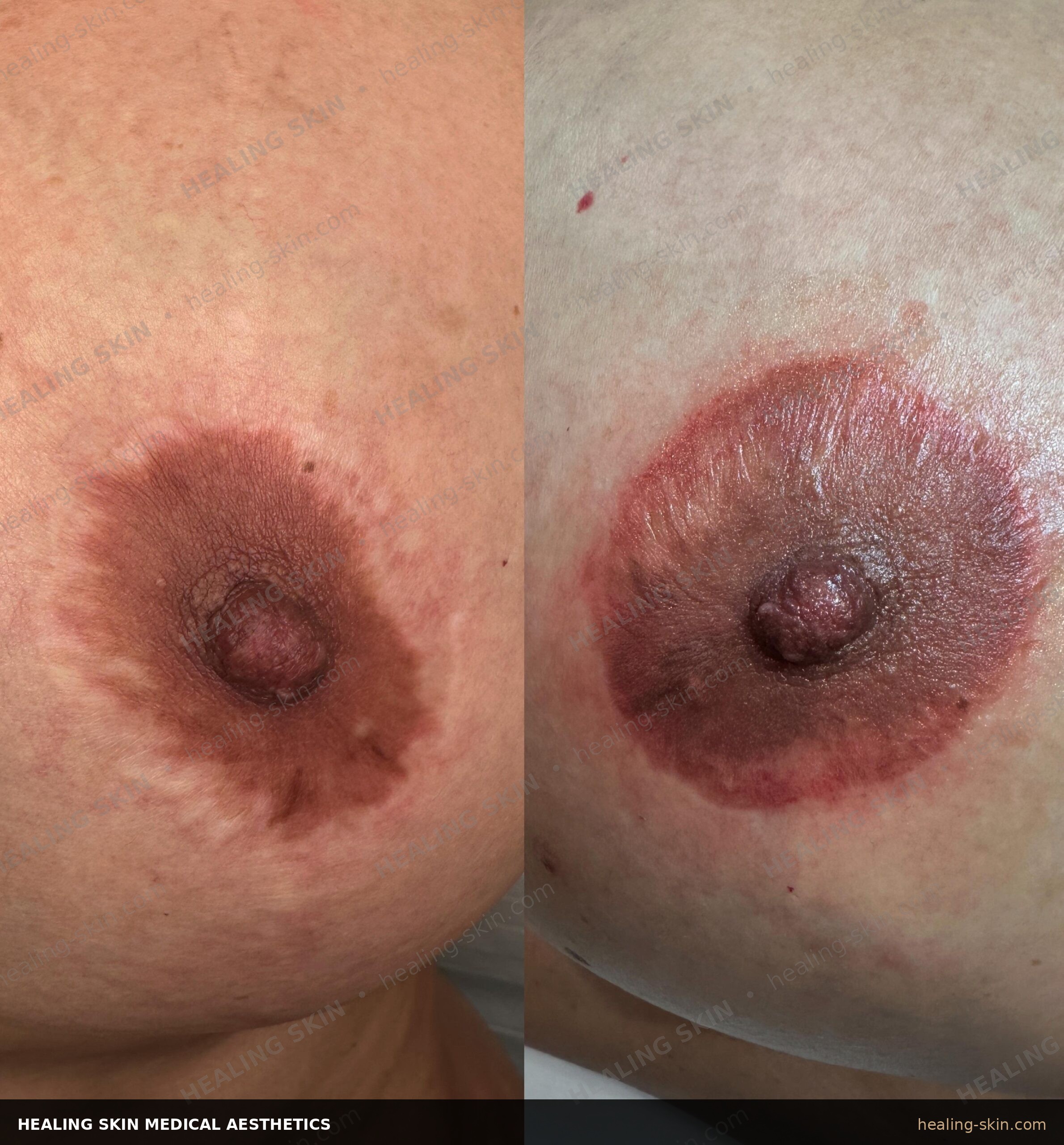 3D areola pigment depth and color