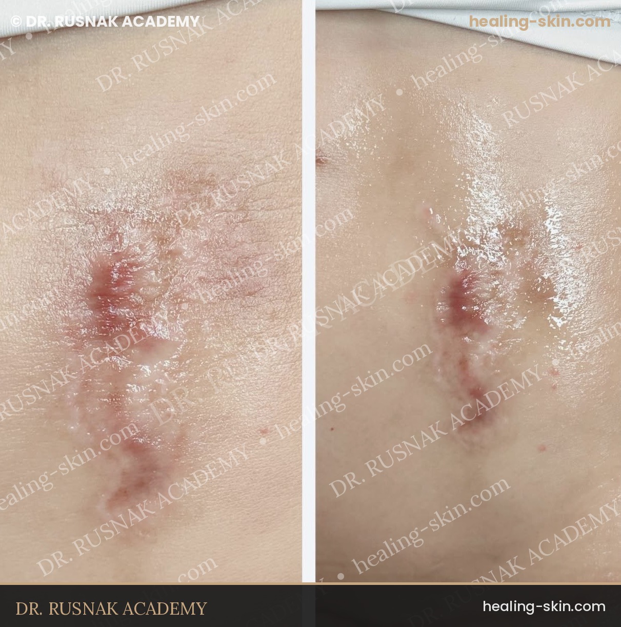 Abdominal scar treatment result