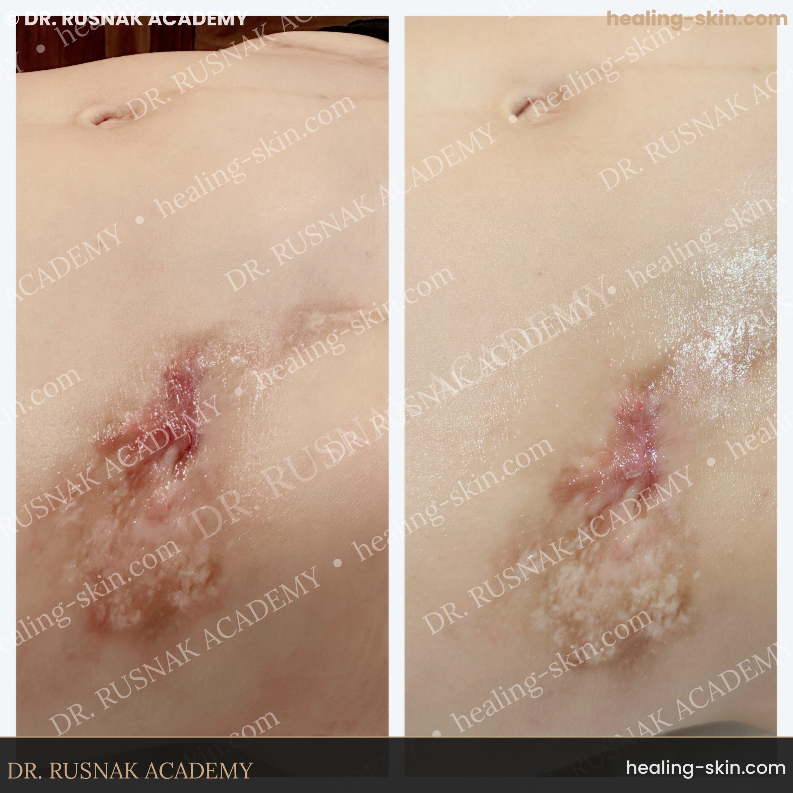 Abdominal scar revision paramedical tattoo