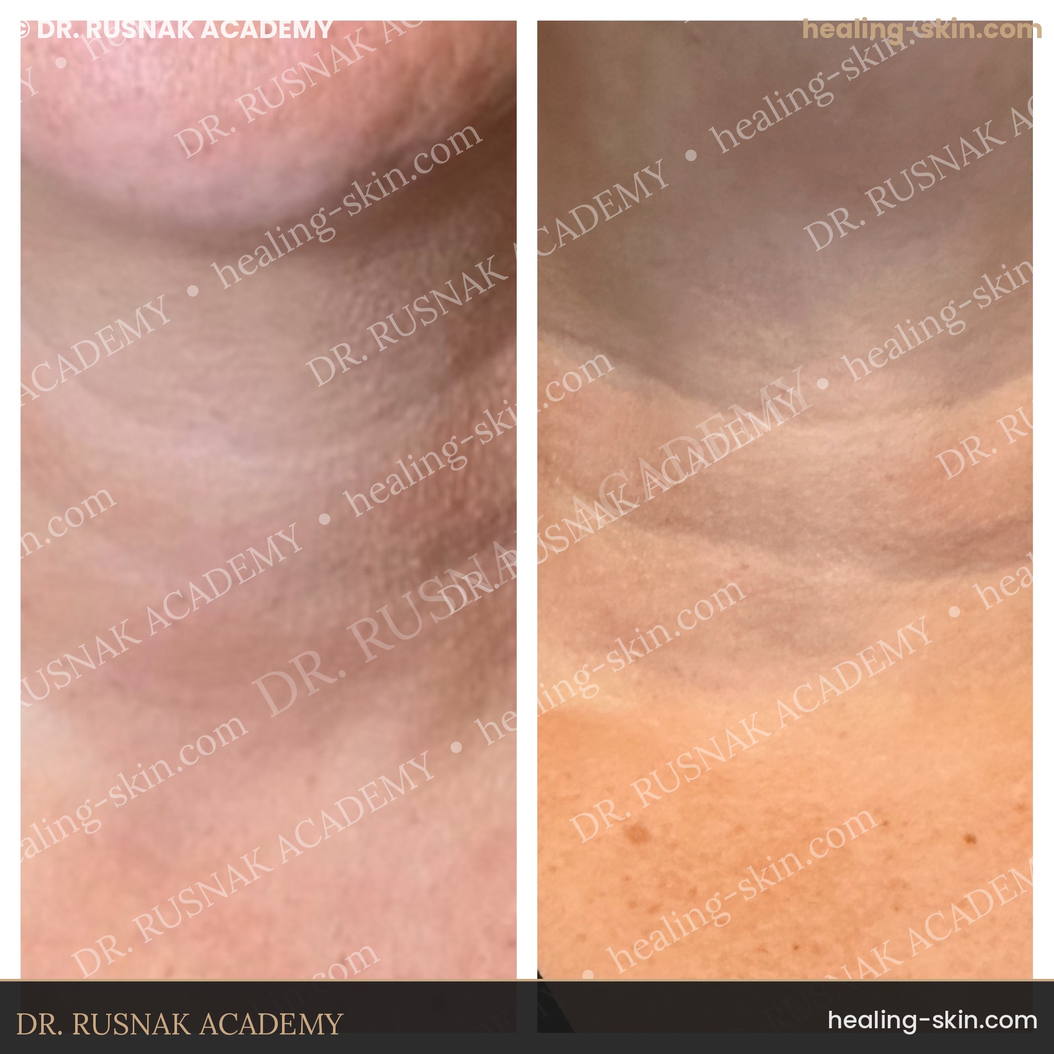 Neck scar camouflage before and after