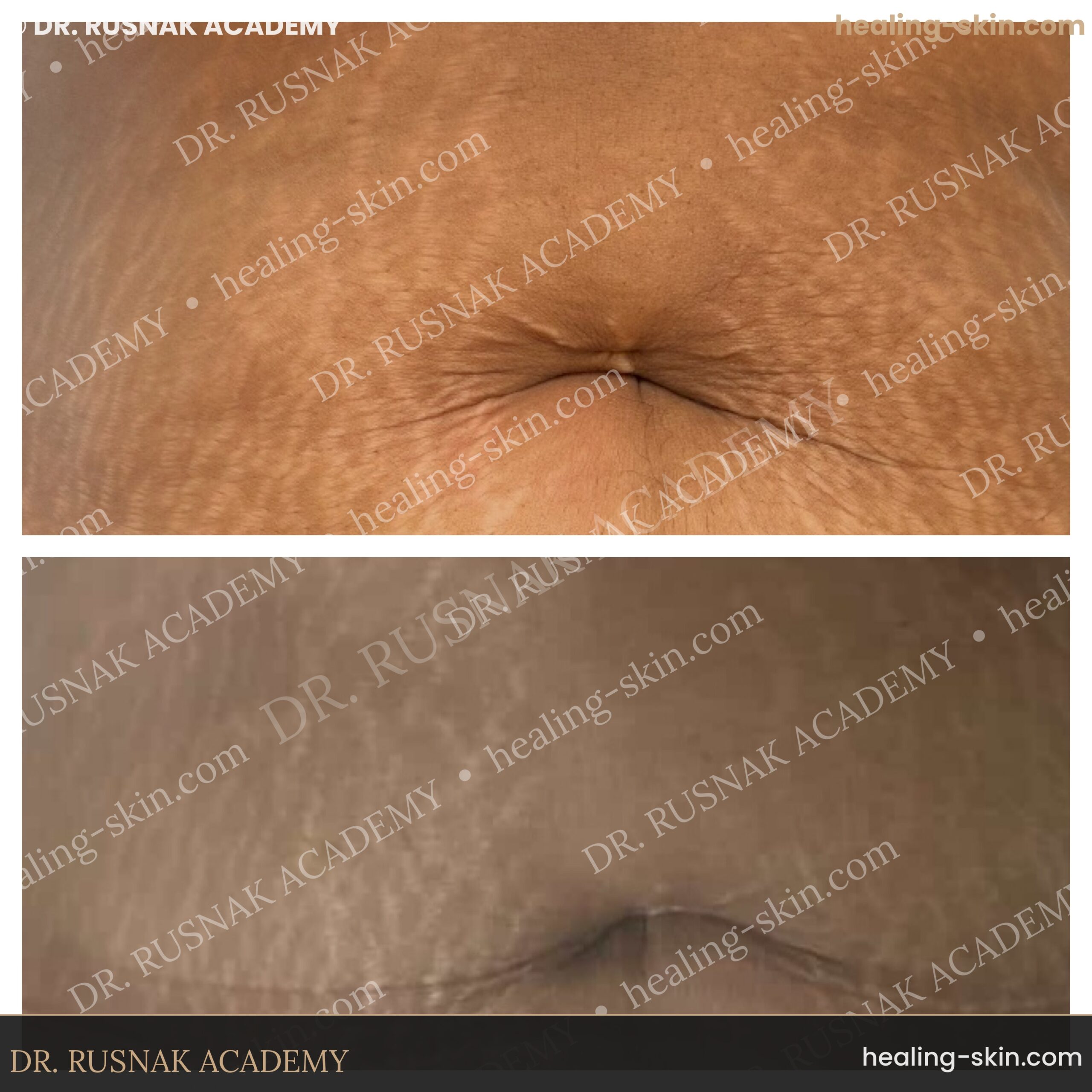 Abdominal stretch marks dramatic improvement