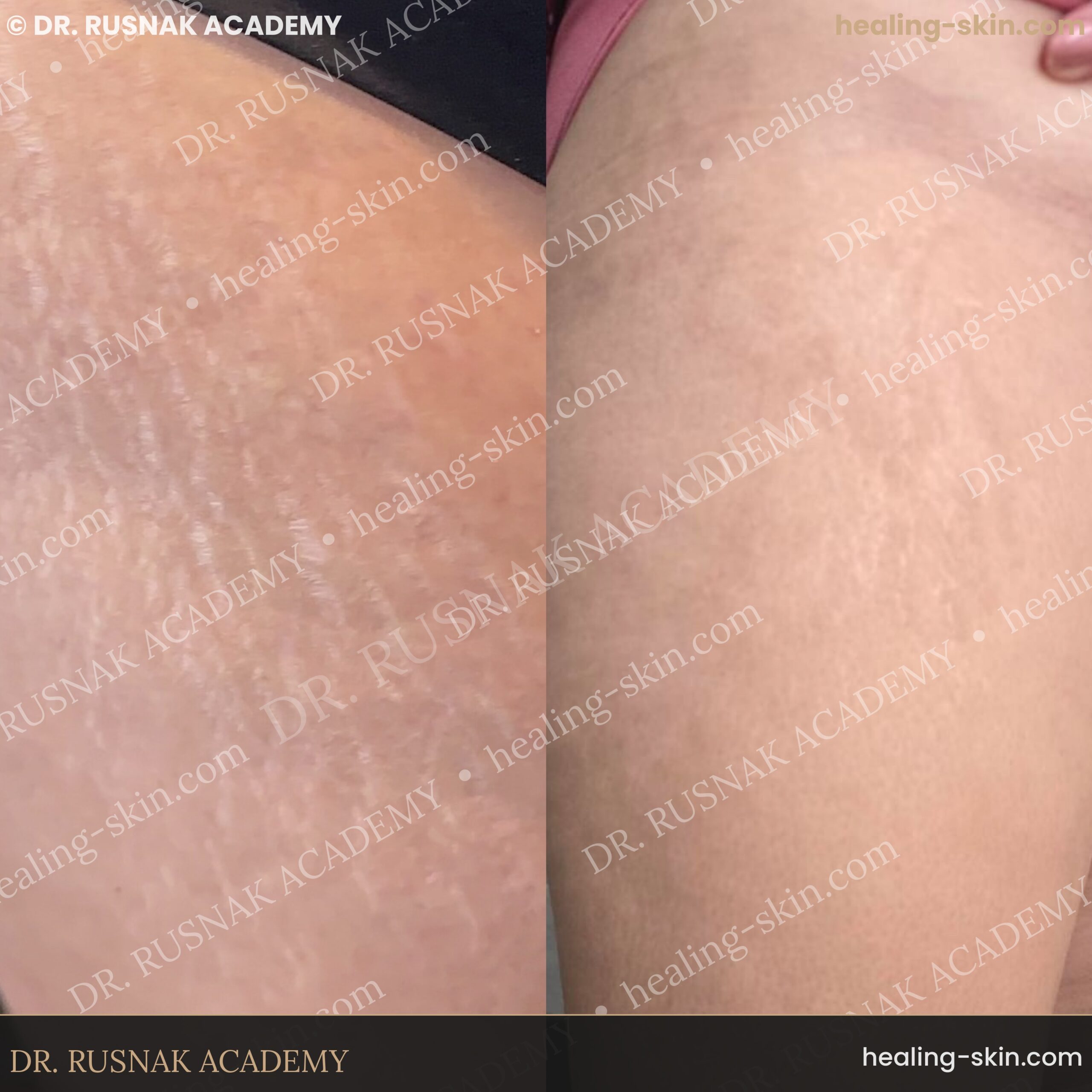 Hip and thigh stretch mark camouflage