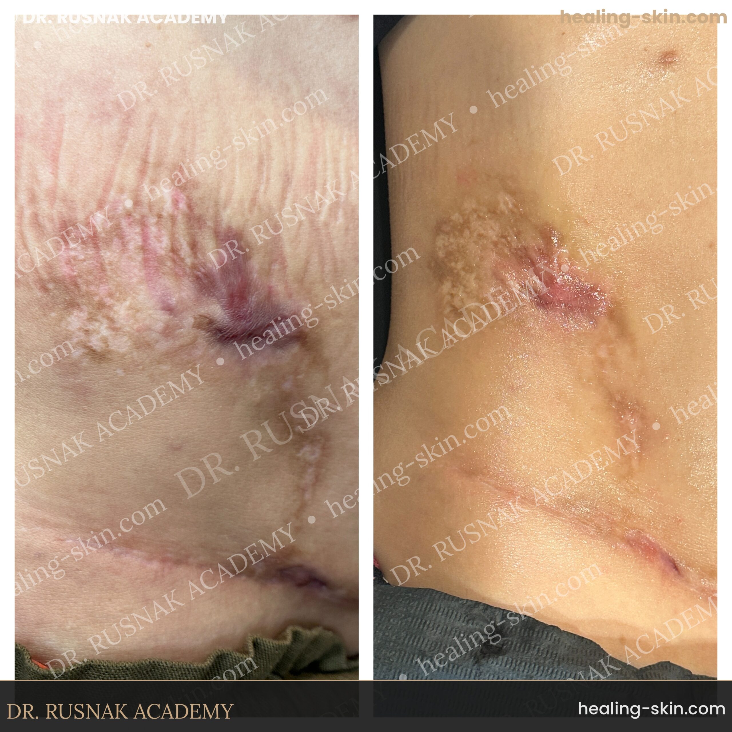 Abdominal stretch mark pigment blending