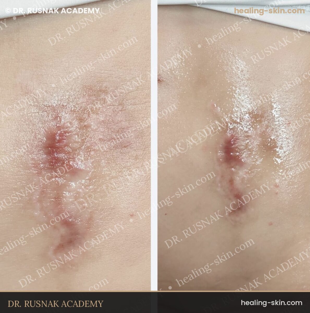 C-Section Scar Camouflage: A Mother’s Guide to Realistic Results