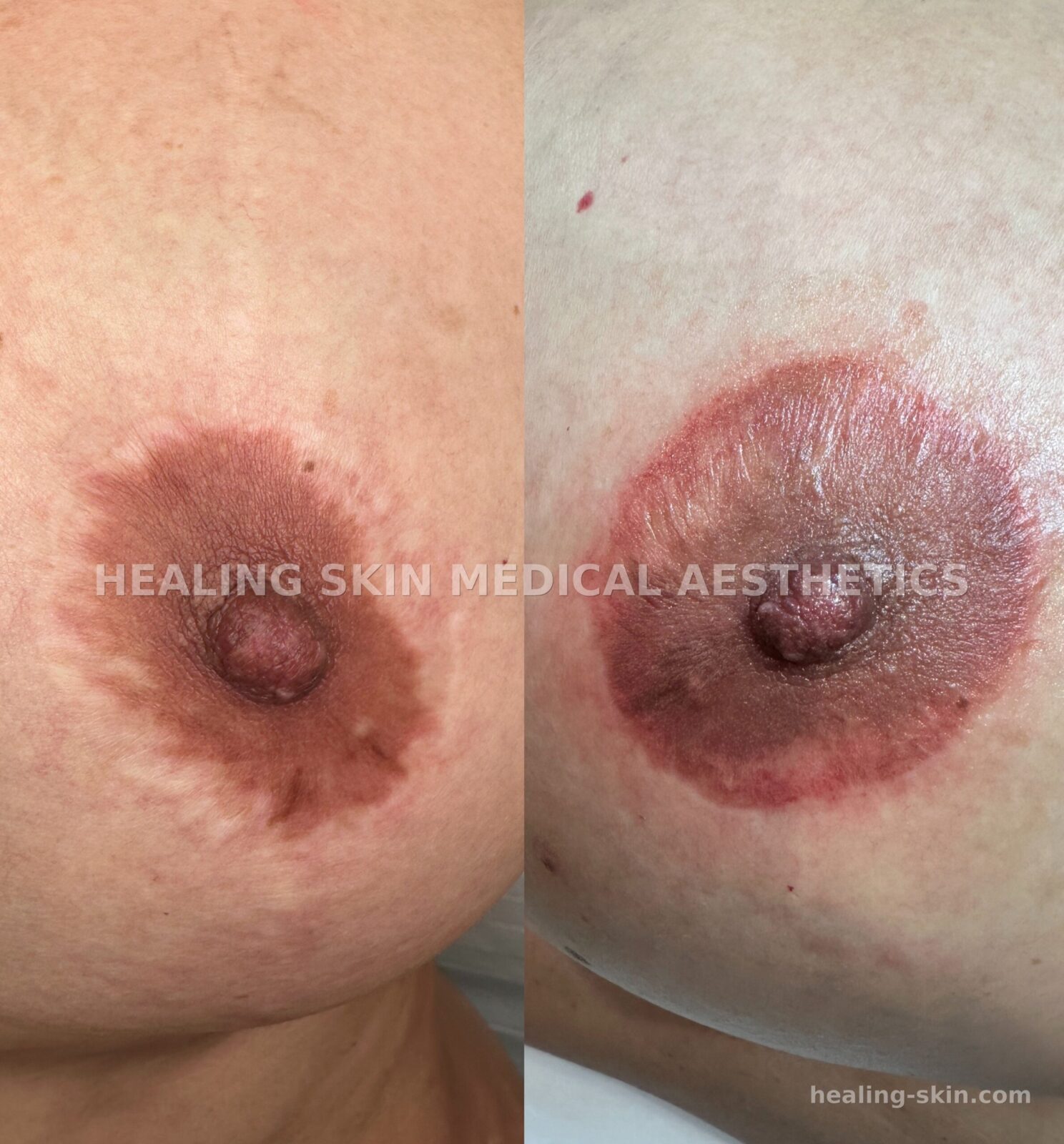 3D areola color restoration before and after at Healing Skin Medical Aesthetics