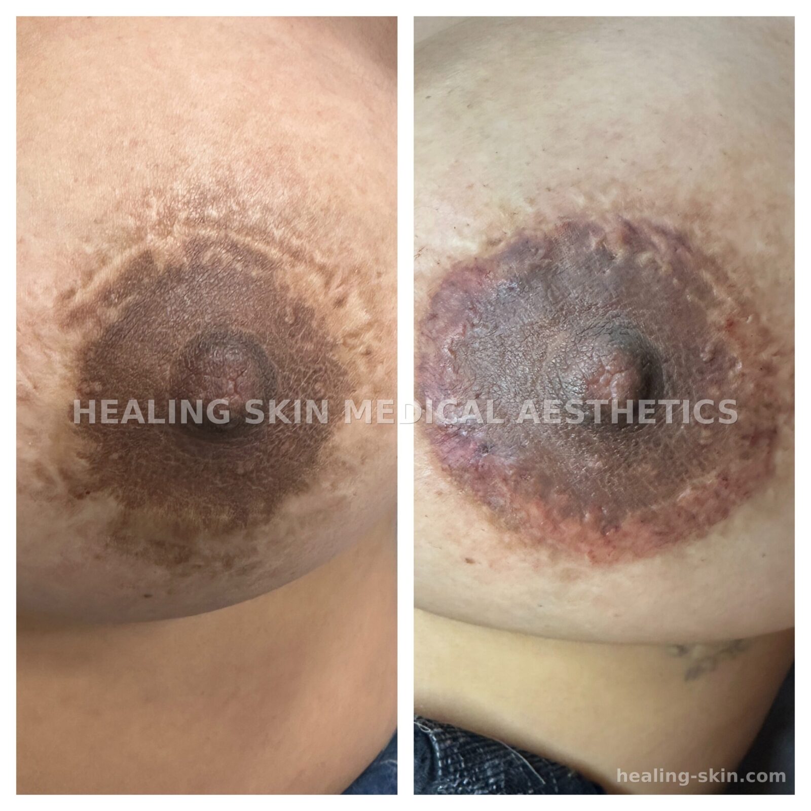 Post-mastectomy areola restoration before and after at Healing Skin Medical Aesthetics