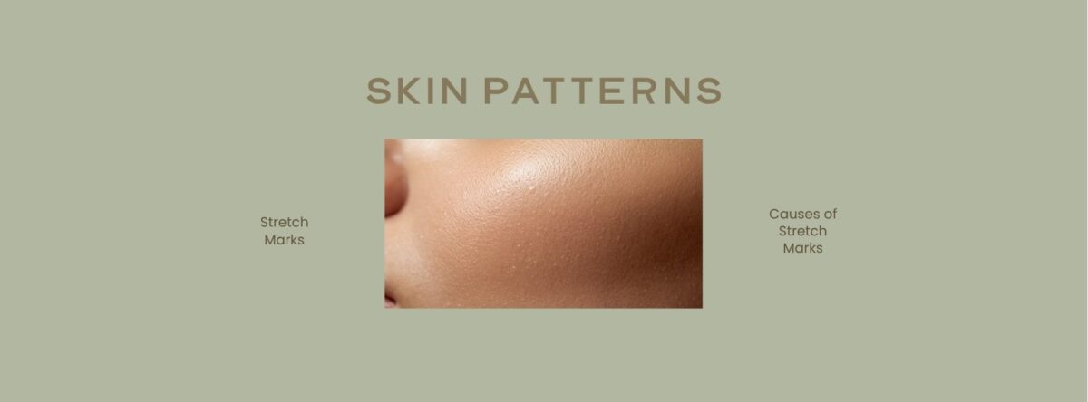 The 5 Honest Causes of Brazilian Stretch Marks