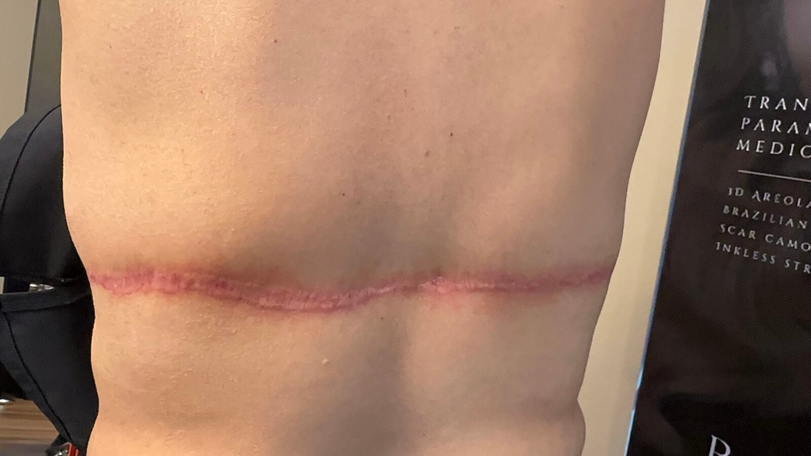 Healed surgical scar treated with paramedical scar camouflage at Healing Skin Medical Aesthetics