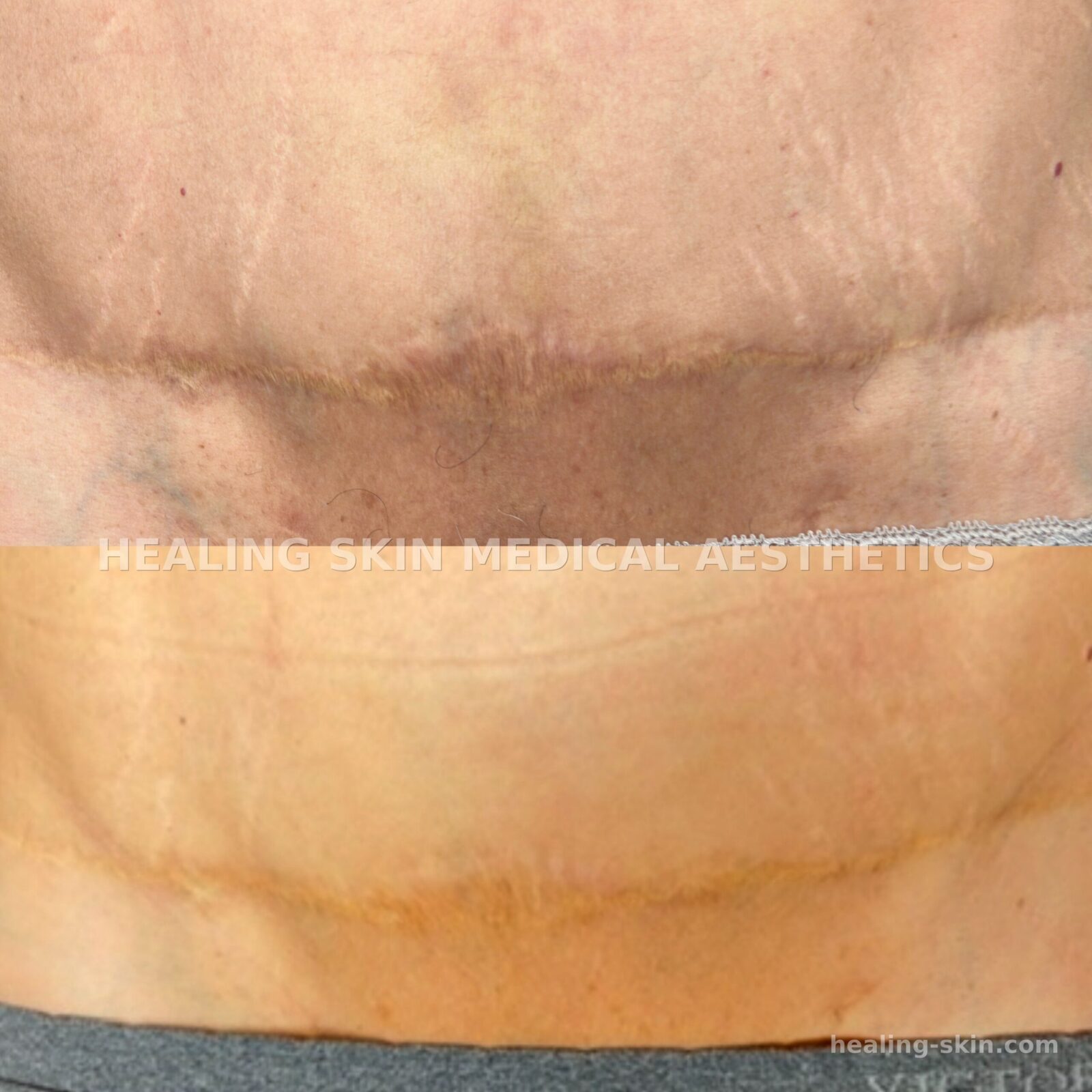 Paramedical tattoo before and after gallery Dr. Cecilia Rusnak