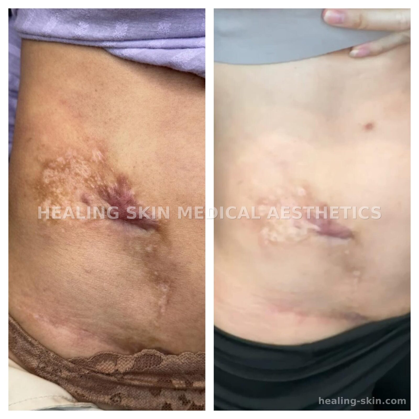 Surgical scar camouflage before and after at Healing Skin Medical Aesthetics