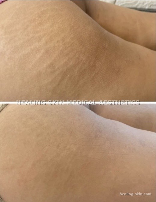 Stretch mark camouflage before and after at Healing Skin Medical Aesthetics