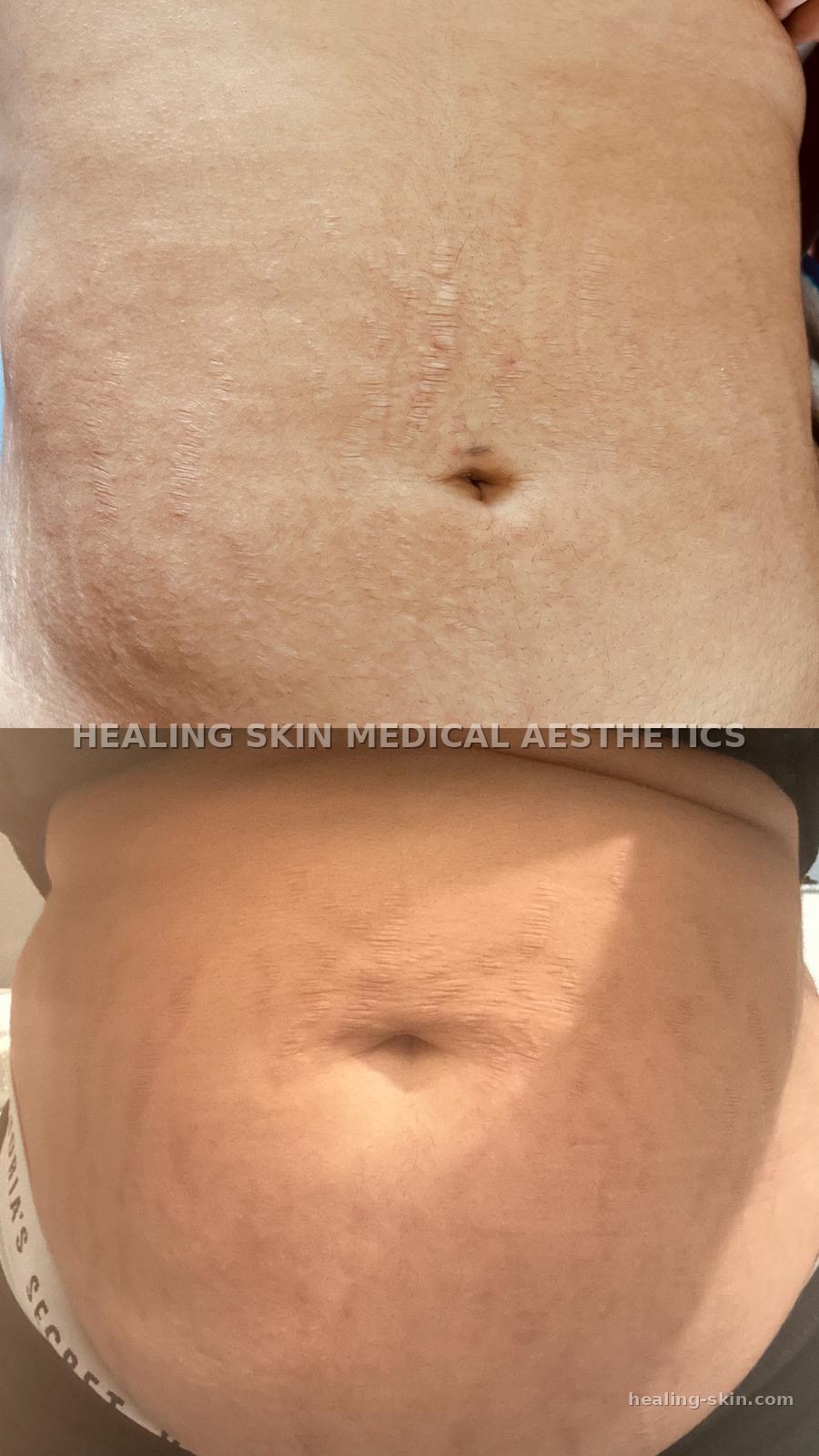 Stretch mark camouflage tattoo before and after at Healing Skin Medical Aesthetics