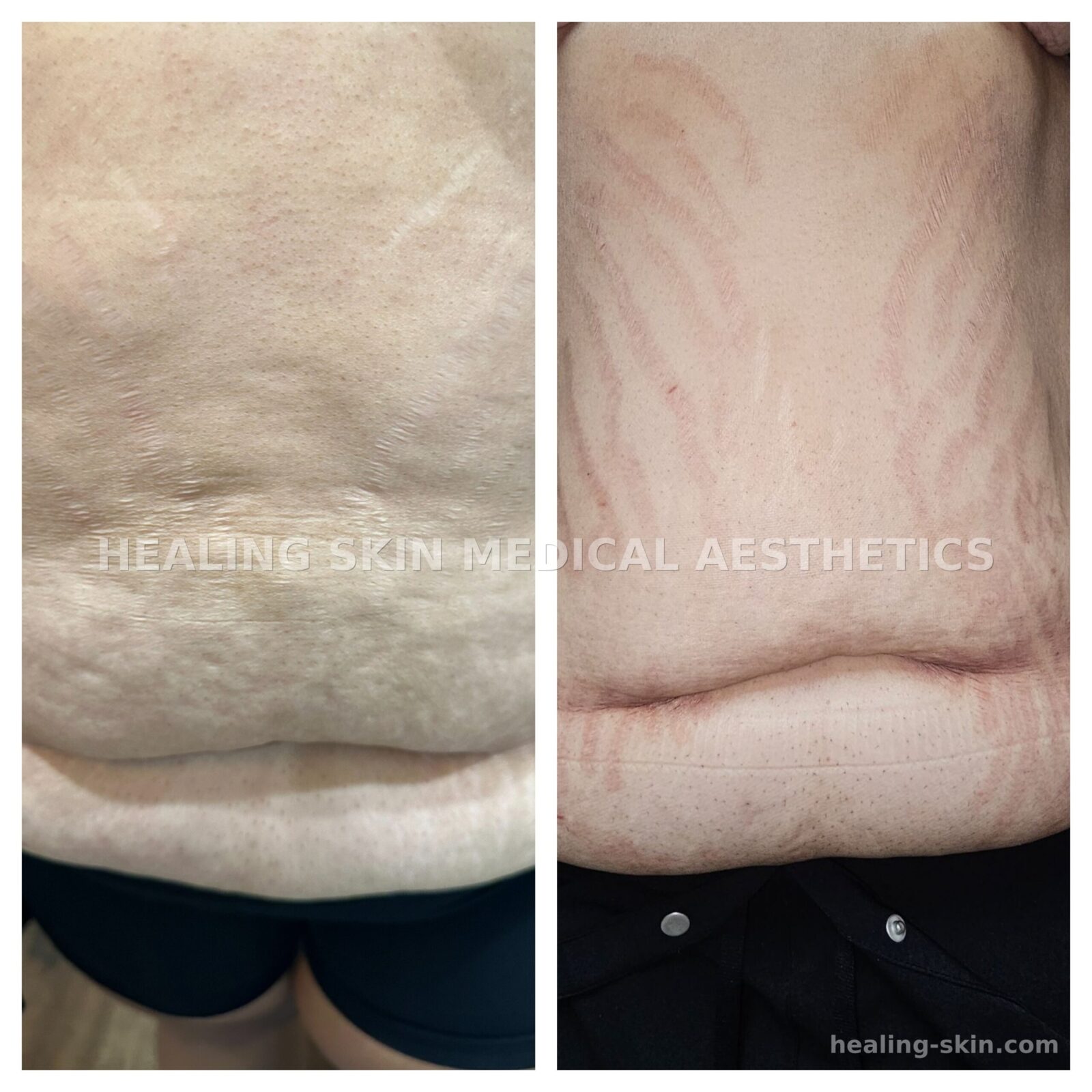 Abdominal stretch mark camouflage before and after at Healing Skin Medical Aesthetics