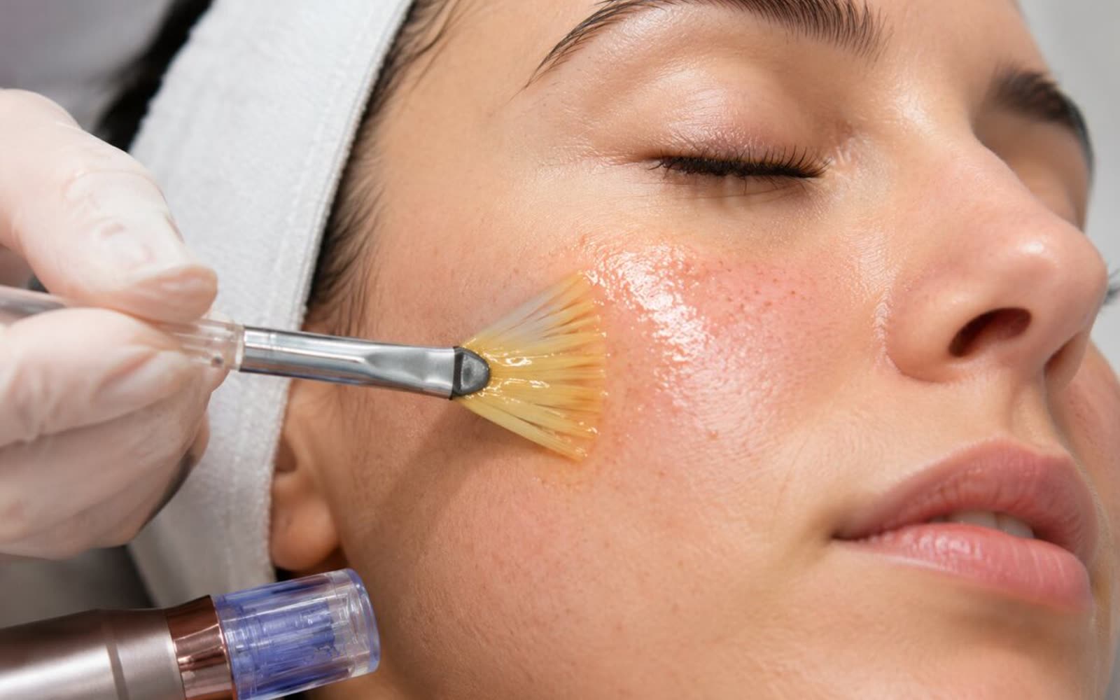 PRP applied through microneedling